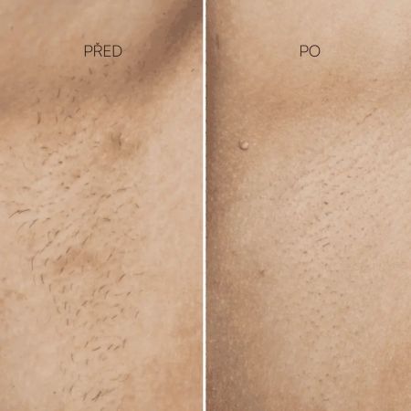 Eggo profesionální IPL zařízení na odstranění chloupků Lumer Pro IPL